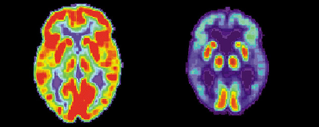 PET scans of healthy brain and Alzheimer's brain.
